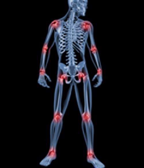 مفاصل،  درد مفاصل، آرتروز، آرتریت،