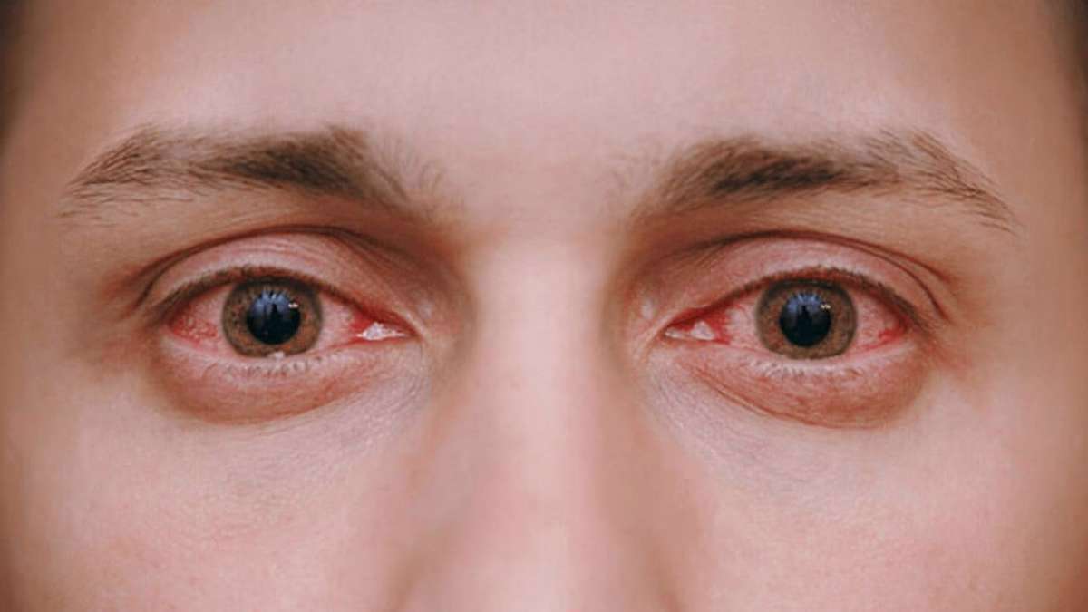 قرمزی چشمها چه زمانی خطرناک است؟ قرمزی چشمها چه زمانی خطرناک است؟