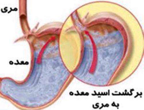 برگشت اسید معده، معده، مری،