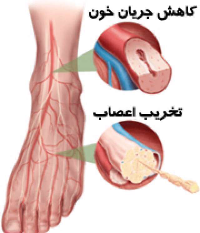 کاهش جریان خون، تخریب اعصاب، بی حسی پاها، نوروپاتی دیابت، آسیب اعصاب،