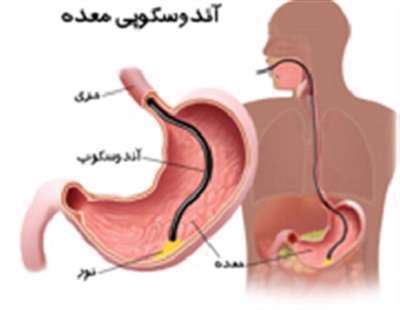 آندوسکوپی معده، مری، معده،