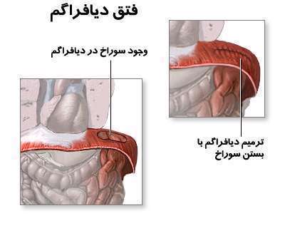 ترمیم دیافراگم، فتق دیافراگم، سوراخ دیافراگم نوزاد،