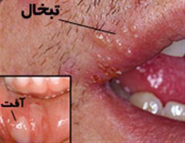 آفت دهان، تبخال، آفت دهان، تبخال،
