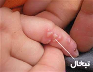 تبخال انگشت، تبخال، تبخال انگشت، تبخال،