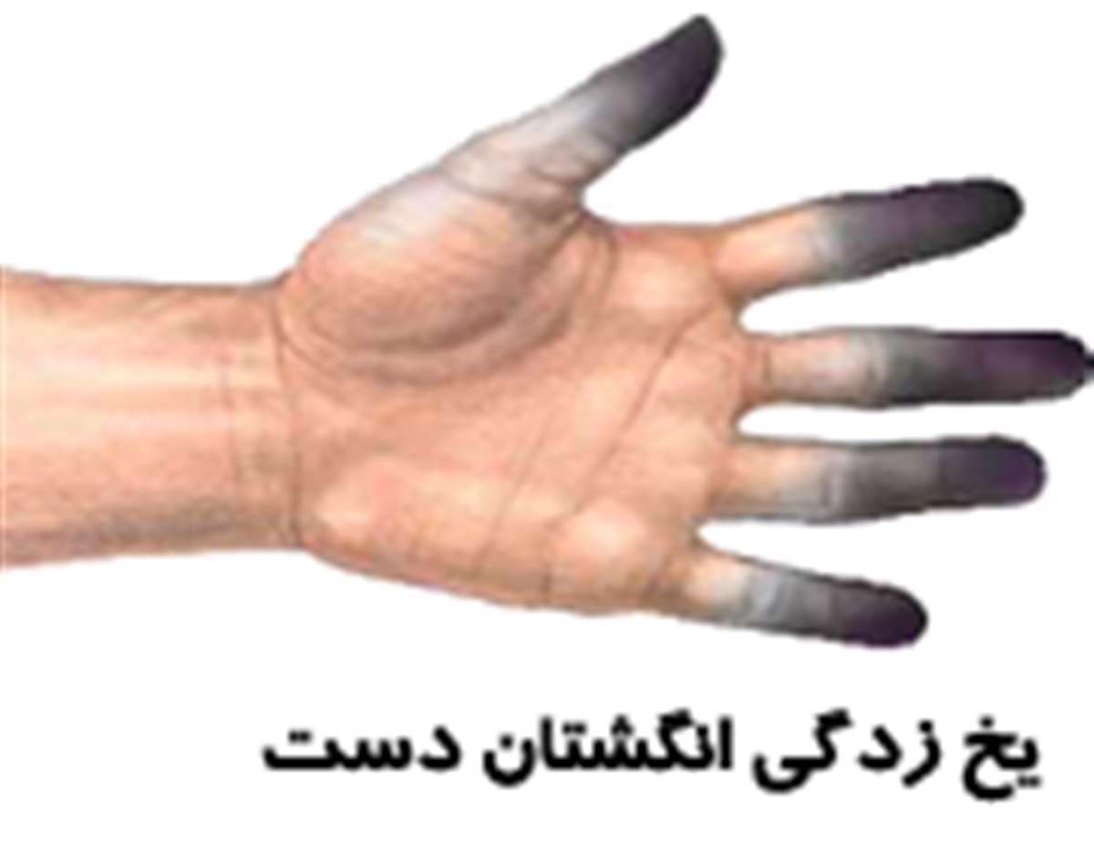 یخ زدگی انگشتان دست