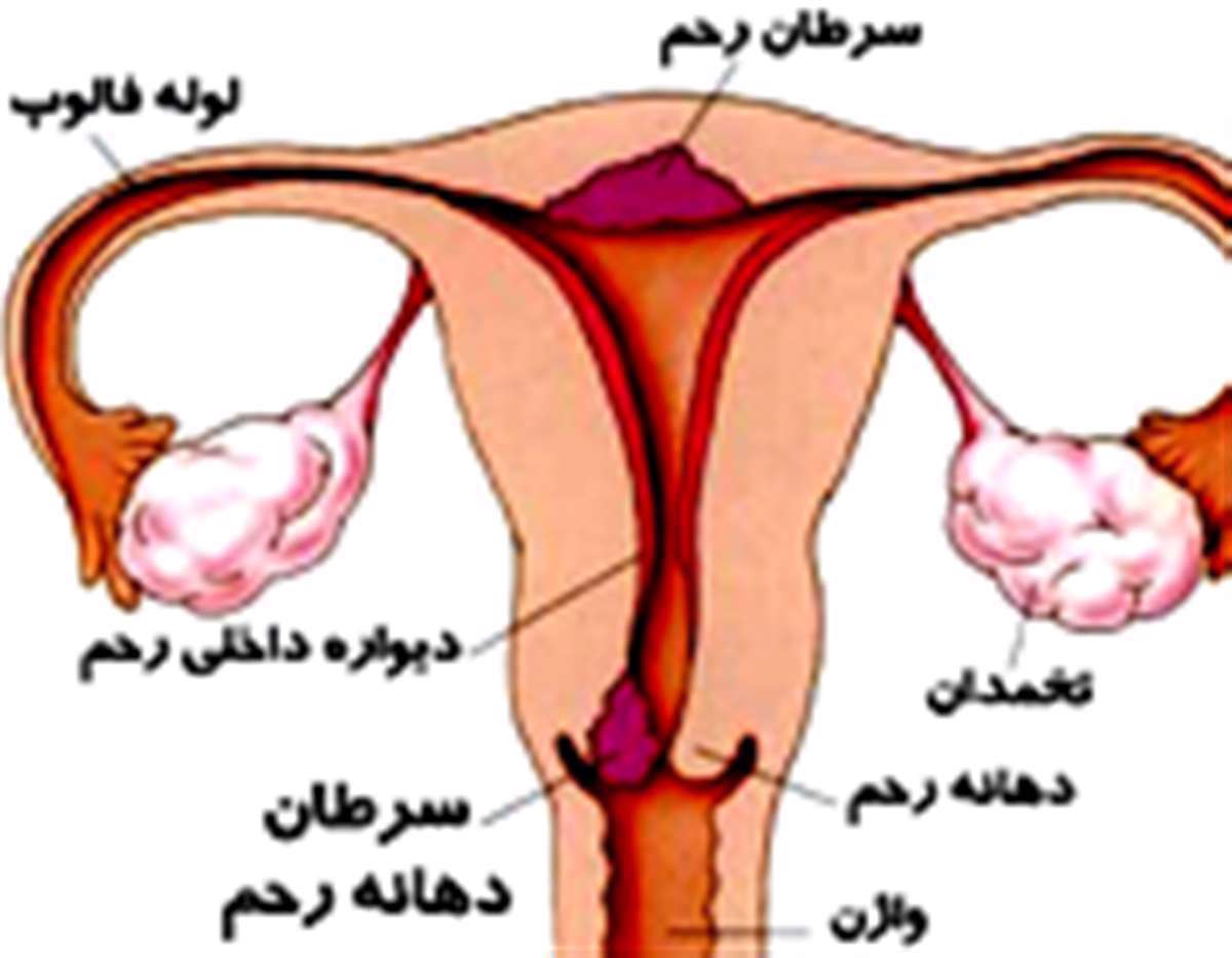 سرطان دهانه رحم در زنان، سرطان، رحم، تخمدان، دیواره رحم،