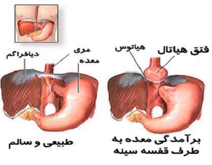 دیافراگم، علائم فتق هیاتال، هیاتوس، معده، مری،