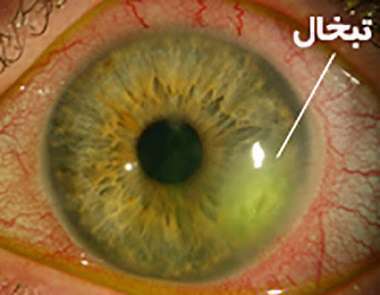 تبخال چشمی، تبخال، تبخال چشمی، تبخال،