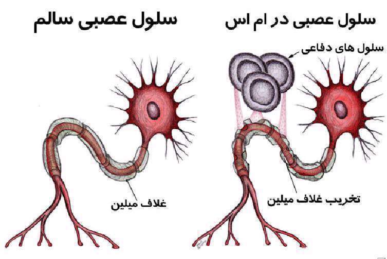 بیماری اماس، غلاف میلین، سیستم عصبی مرکزی، سلول عصبی،