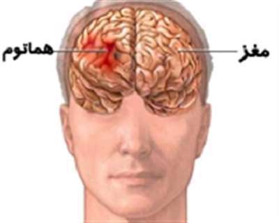 مغز، هماتوم