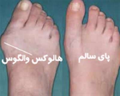 هالوکس والوکس، پینه پا هالوکس والوکس، پینه پا