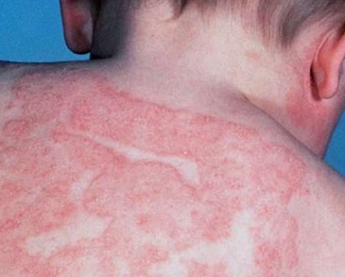 اگزما خشکی پوست، خارش، حساسیت پوست، قرمزی پوست،