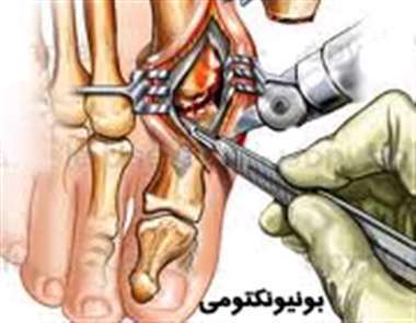 جراحی، بونیونکتومی، جراحی، بونیونکتومی،