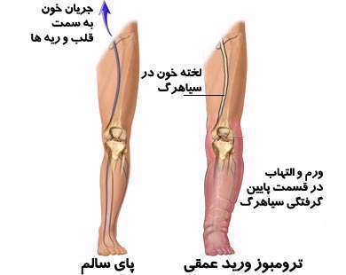 ترومبوز ورید عمقی، درد و ورم پاها، لخته شدن خون در پاها،
