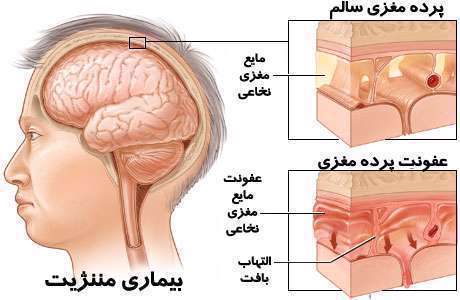 مننژیت، meningitis، التهاب و عفونت پرده مغزی،