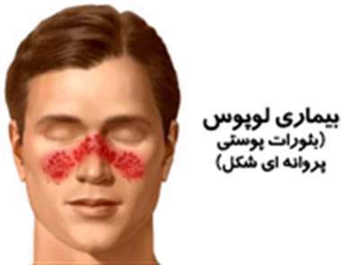 بیماری لوپوس، بثورات پوستی،