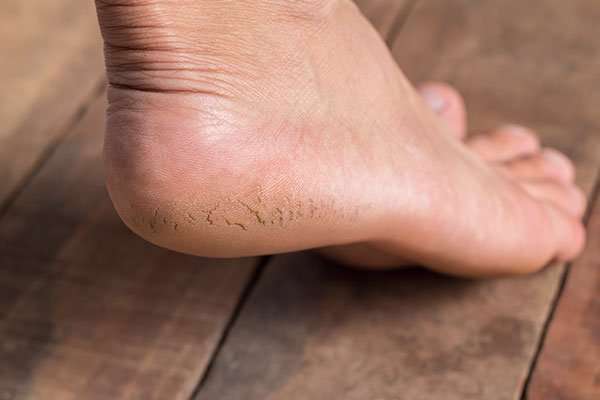 ترک پا، خشکی پوست، ترک پاشنه پا ،