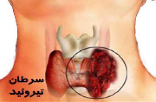 سرطان تیروئید،