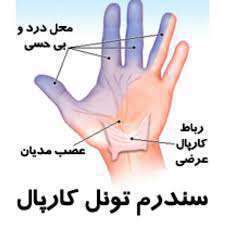 سندرم تونل کارپال