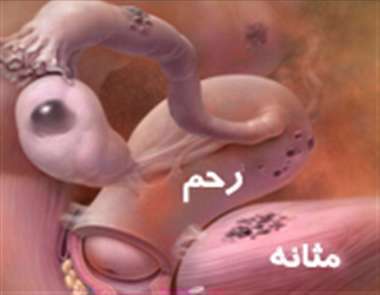 اندومتریوز