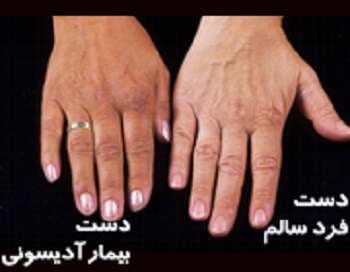 بیماری آدیسون