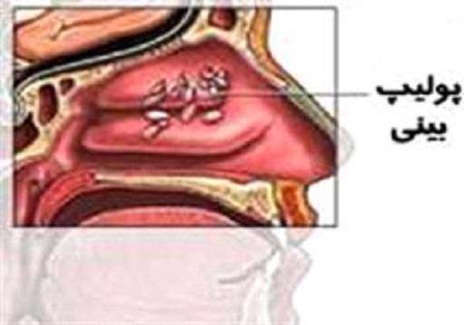 Полип Носа Симптомы Фото