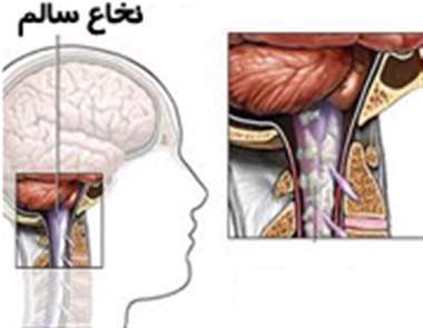 بیماری اماس، نخاع سالم، بیماری،
