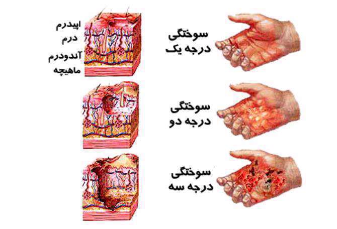 سوختگی پوست، سوختگی درجه 1، سوختگی درجه 2 و سوختگی درجه 3
