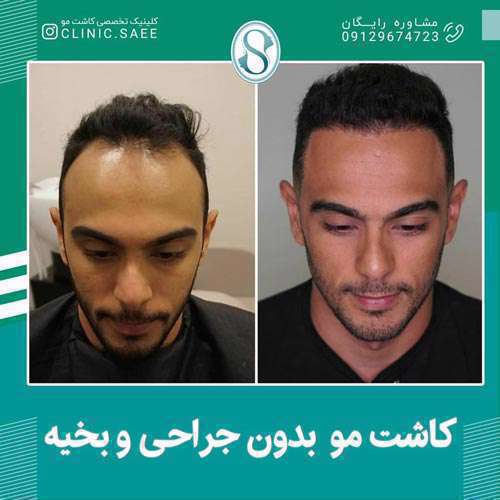 کاشت مو بدون جراحی و بخیه