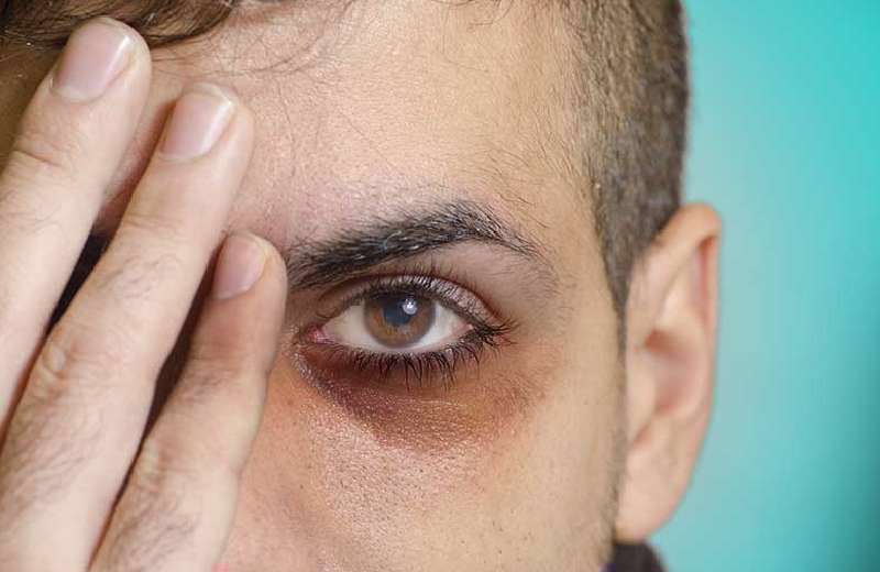 تیرگی زیر چشم