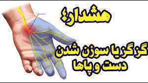 خواب رفتگی