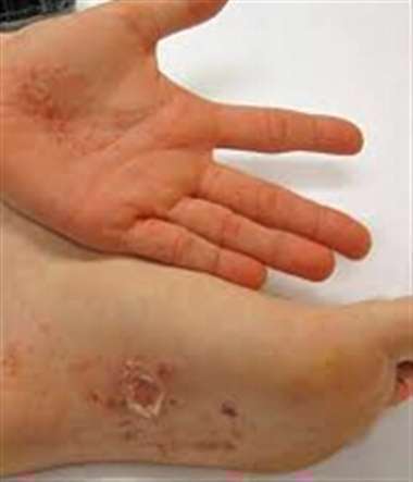 درماتیت dyshidrotic - اگزما کف دست و پا