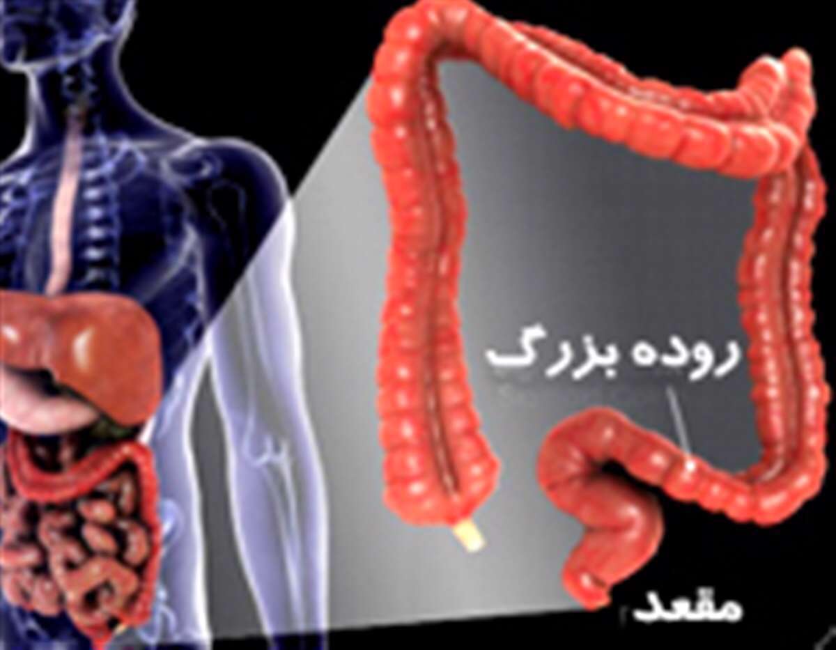 سرطان کولورکتال - سرطان روده بزرگ و مقعد -