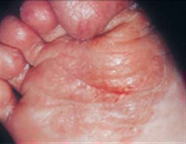 عفونت قارچی pedis و یا پای ورزشکار