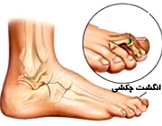 انگشت چکشی