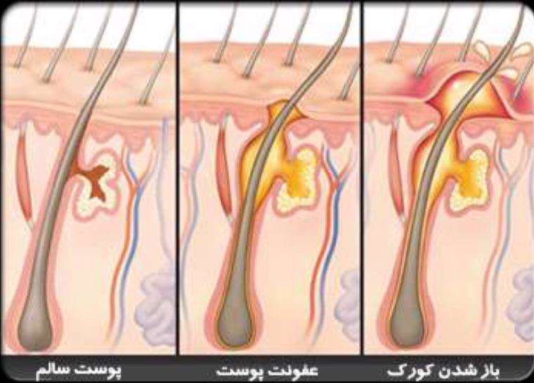 کورک - آبسه مو - غده چربی