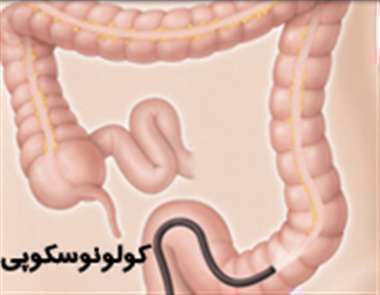 کولونوسکوپی - بیماری های التهابی روده