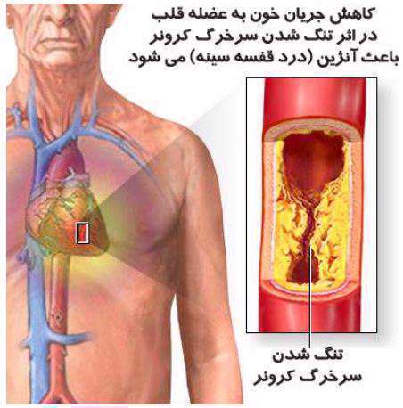 آنژین - درد قفسه سینه - عضلات قلب - بیماری عروق کرونر قلب -