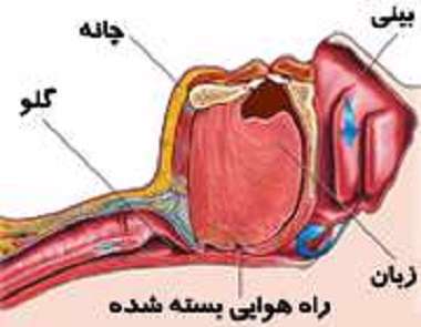 آپنه خواب - گلو - بینی - خستگی - خواب