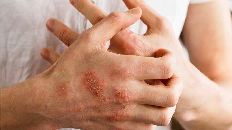 درماتیت تماسی - مشکل پوستی