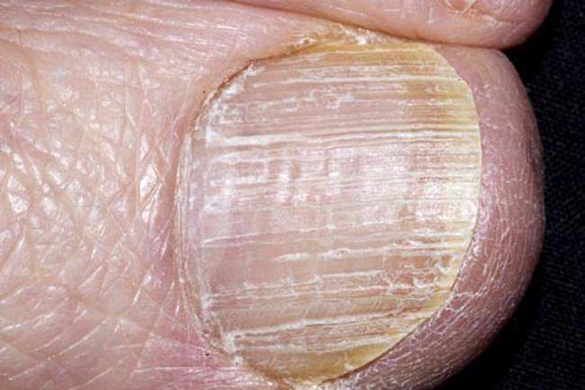 فرورفتگی و سوراخ سوراخ شدن ناخن
