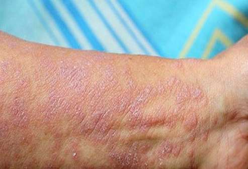 خراش و برآمدگی های بنفش بر روی مچ دست - بیماری لیکن پلان - بیماری پوست