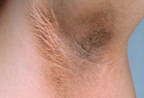 پلاک های مخملی - پوست و سلامتی - مشکلات پوست