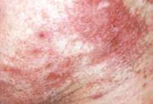 دانه ی فلس دار بر روی باسن و زبان قرمز - مشکلات پوست