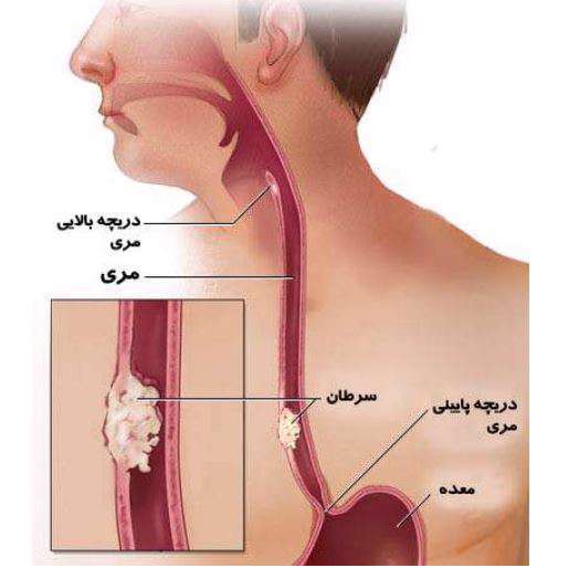 سرطان مری، آدنوکارسینوما، سرطان سلول های سنگفرشی،