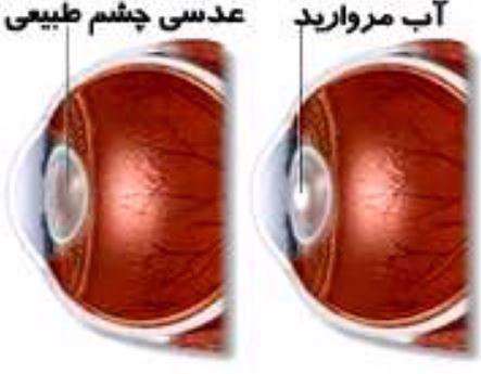آب مروارید، کاتاراکت ، تاری دید،