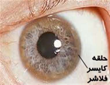 حلقه کایس فلاشر ، چشم،