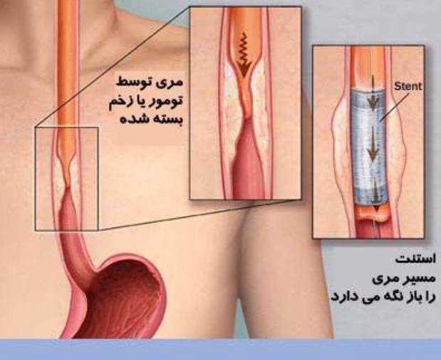 سرطان مری ، باز کردن مسیر مری، استنت در مسیر مری، تومور، زخم مری،