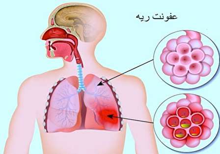 عفونت ریه ، ذات الریه ، پنومونی، عفونت ریه ، ذات الریه ، پنومونی،