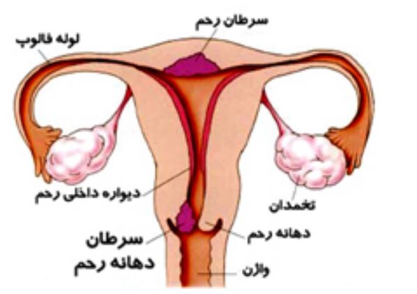 سرطان دهانه رحم در زنان سرطان دهانه رحم در زنان